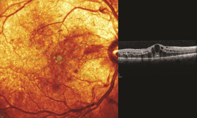 Postoperative complications The Cataract Course