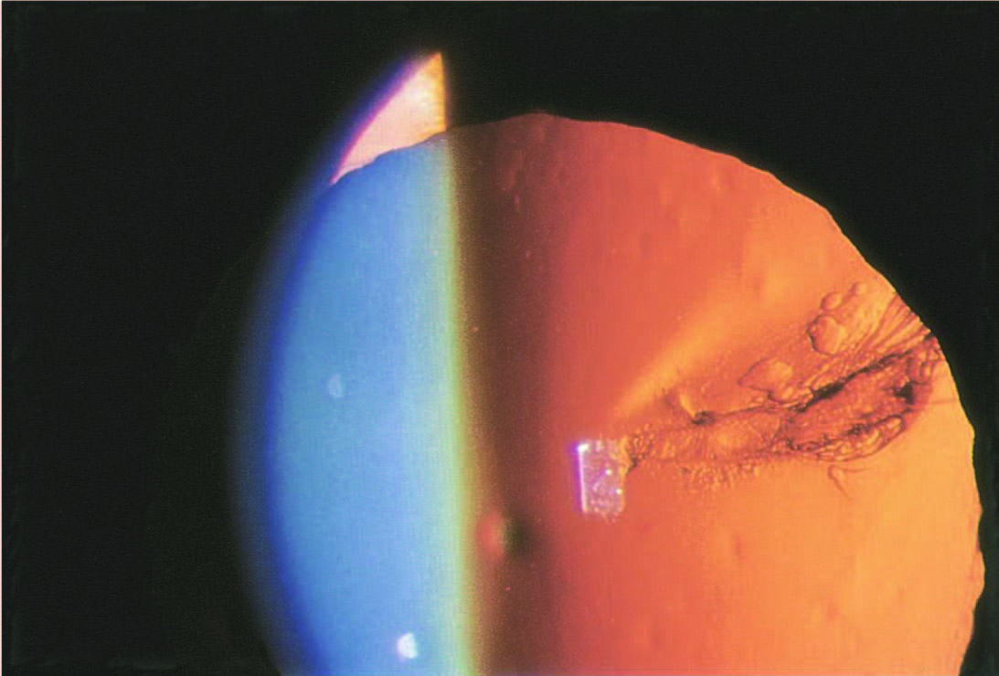 focal-segmental-cataract-panel-b-01