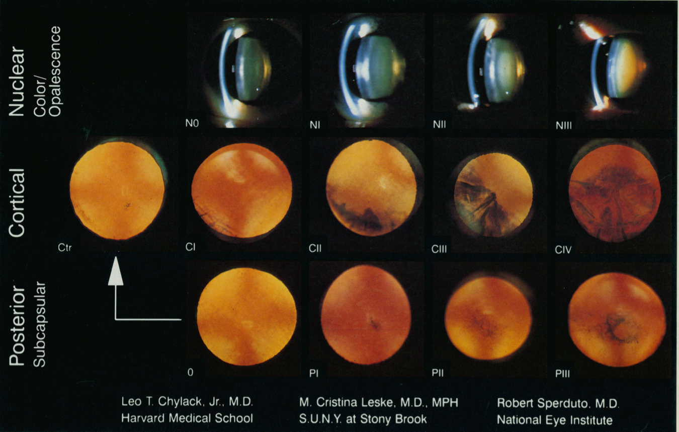 posterior subcapsular cataract