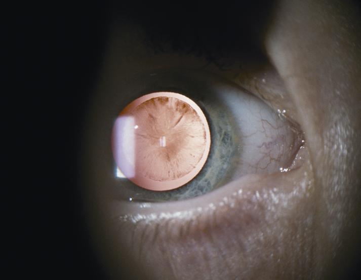 lamellar-cataract-aa0_5008