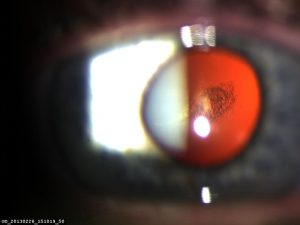 posterior subcapsular cataract