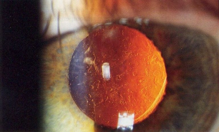 posterior-capsular-opacification-on-retroillumination-the-cataract-course