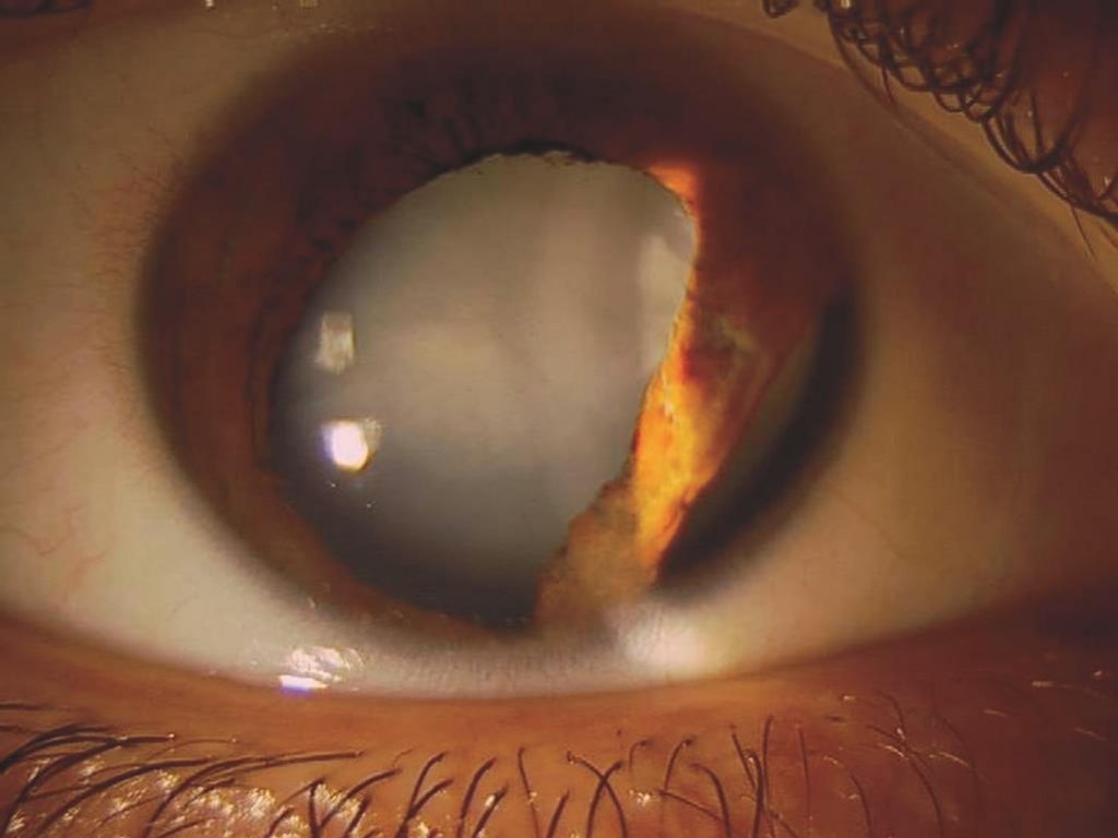 Lens opacification - The Cataract Course